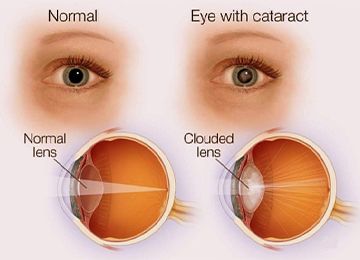 catract-eye
