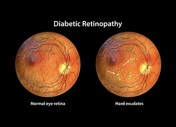 diabetic-retinopathy-screening-and-treatment