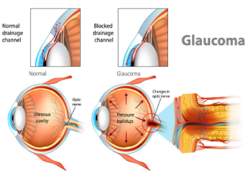 glaucoma-surgery-treatment