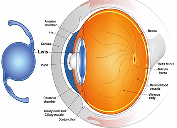 multifocal-IOL