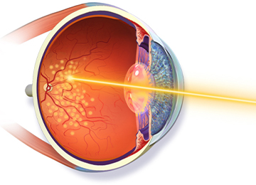 Retinal Surgery / Laser Treatment