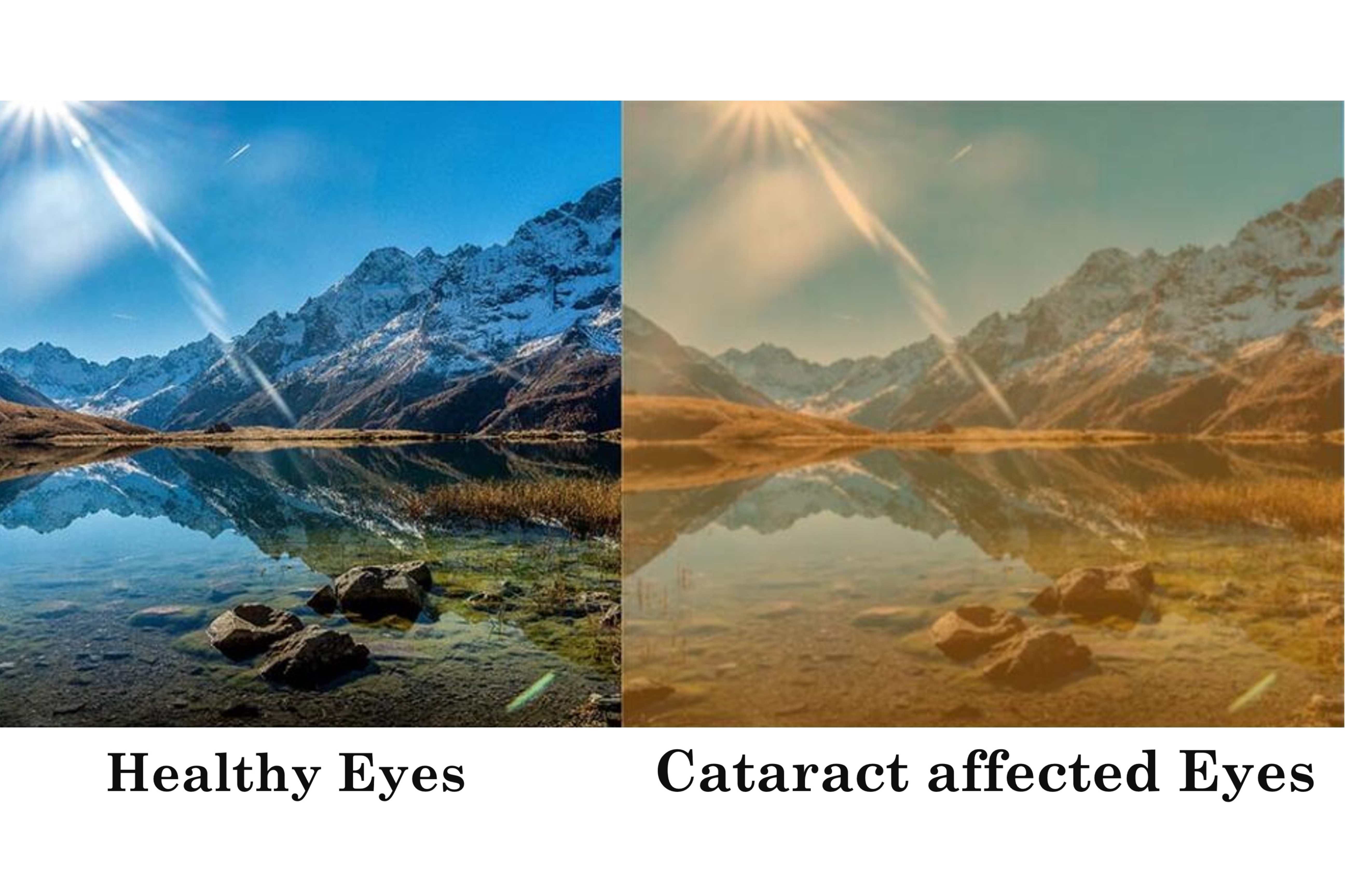 cataract