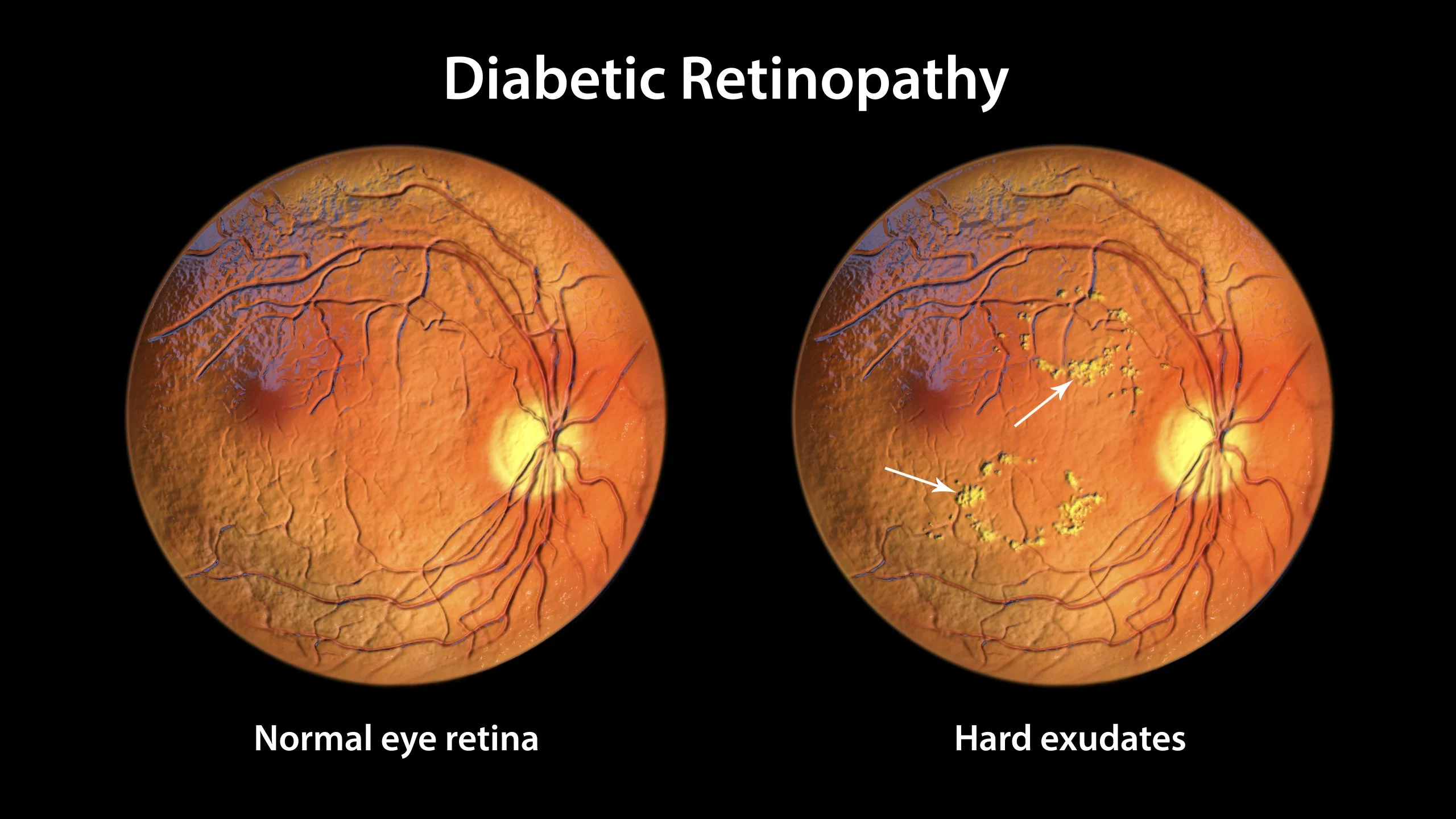 diabetic-retinopathy-screening-and-treatment