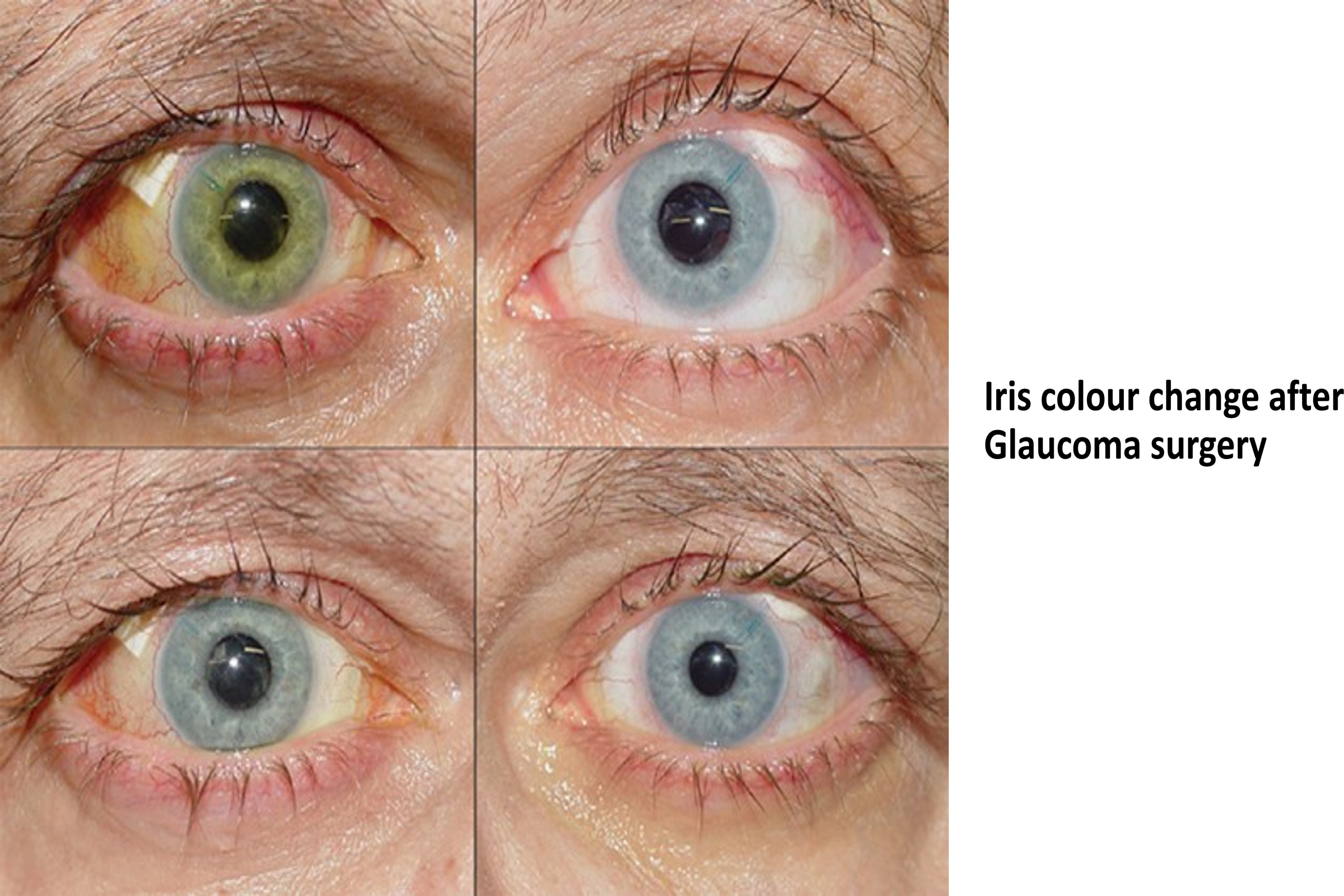 glucoma-treatment