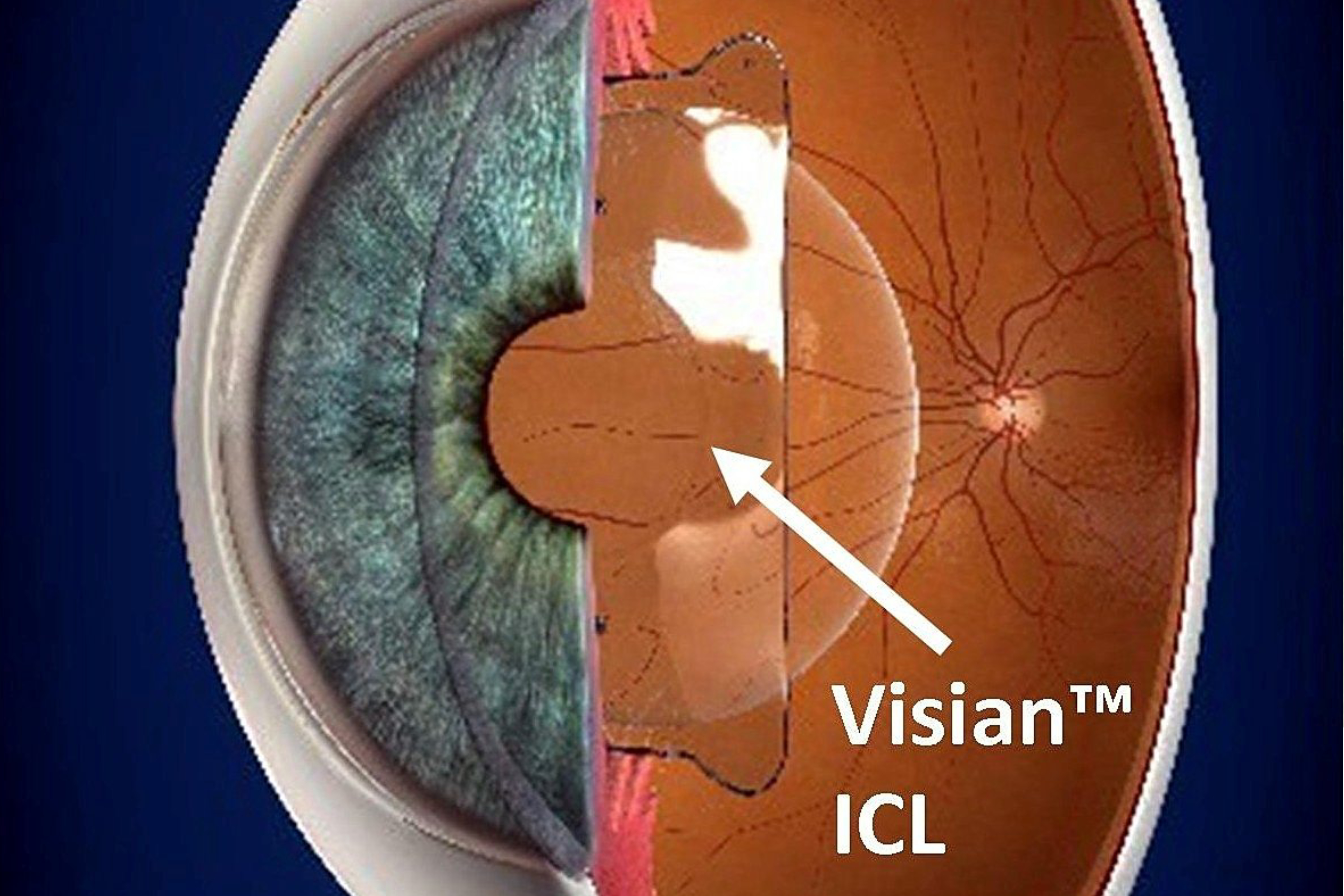 implantable-collamer-lens