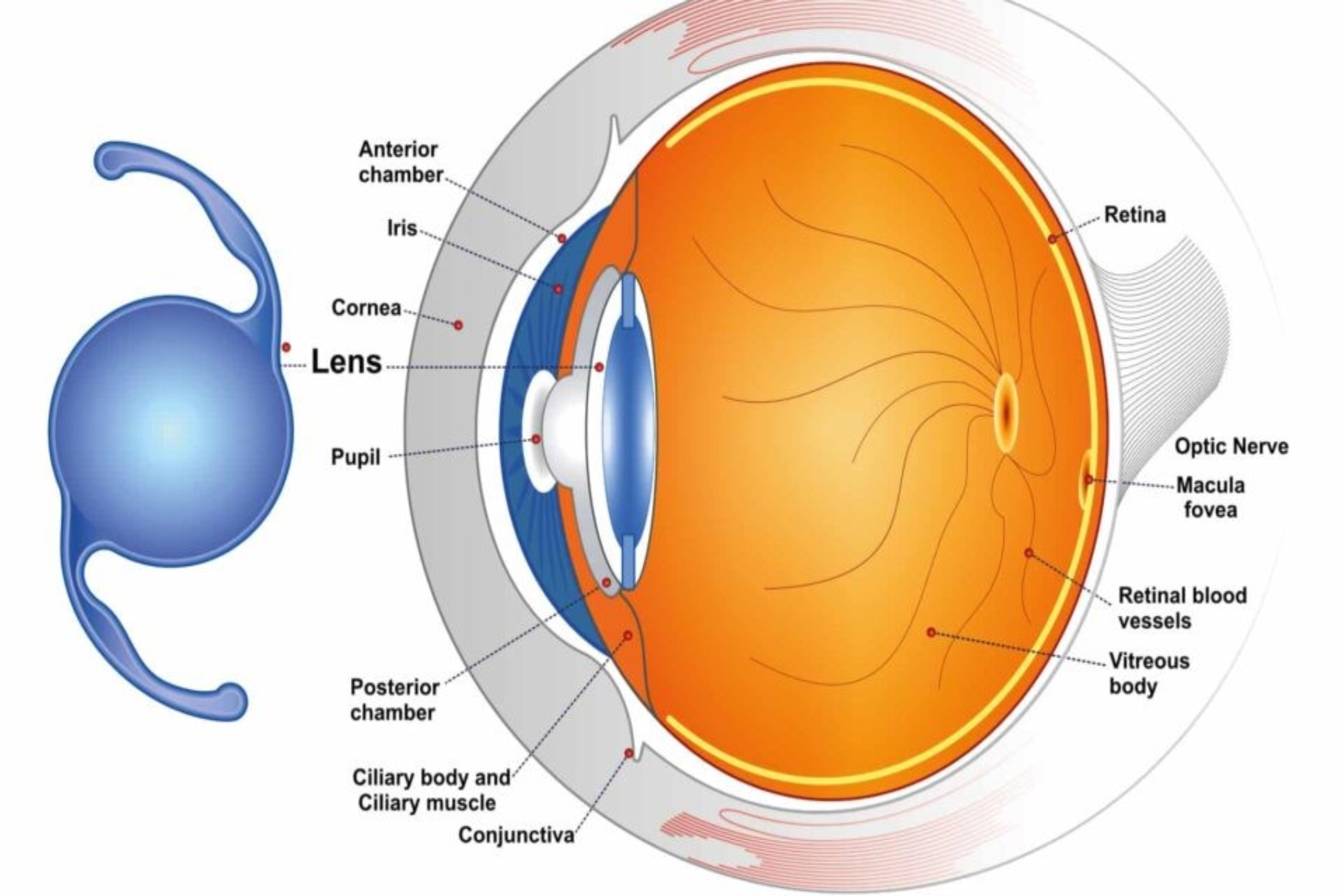 multifocal-IOL