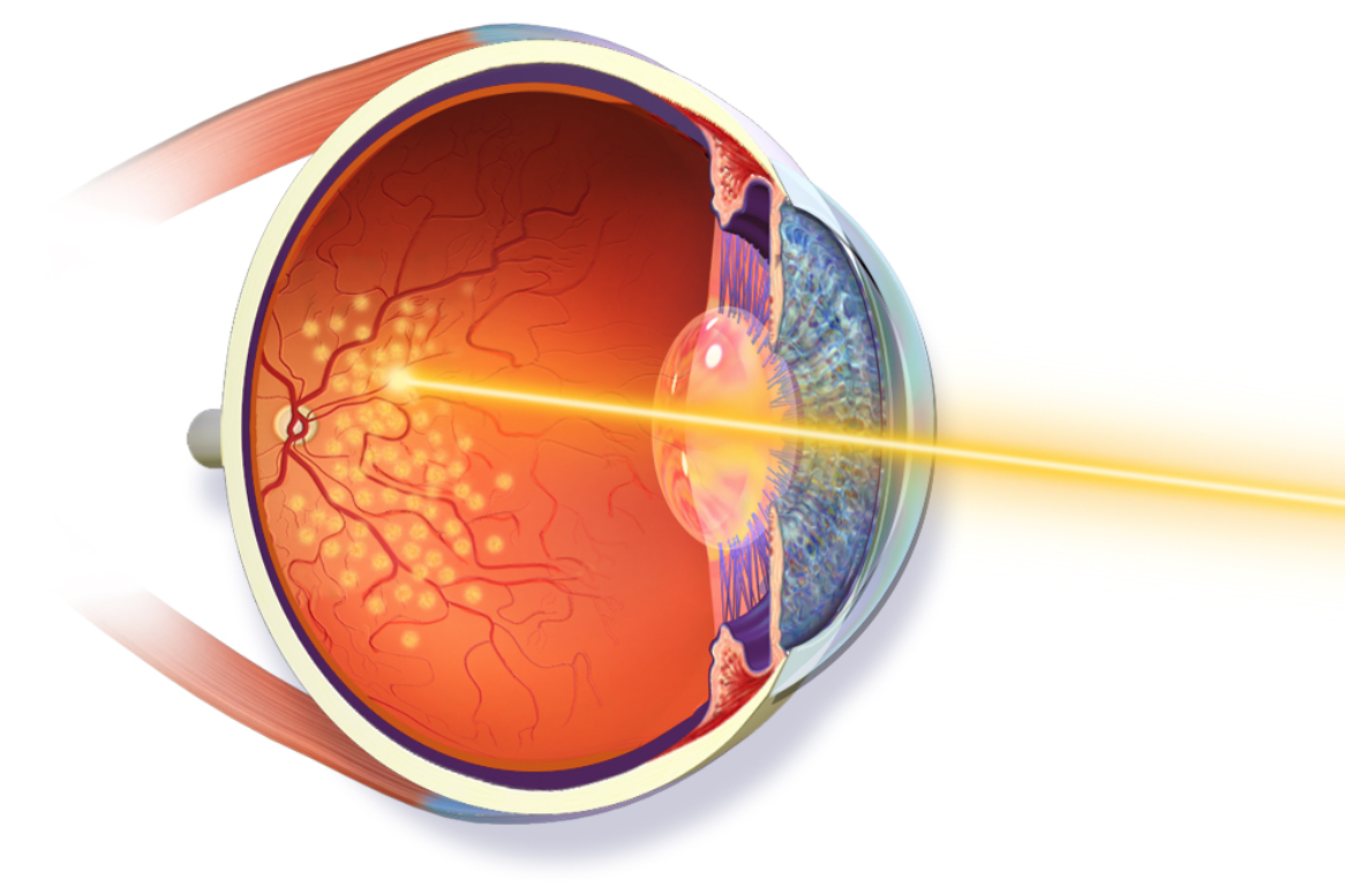 Retinal Surgery / Laser Treatment
